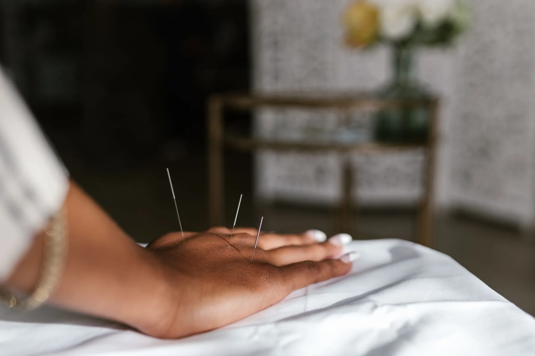 Acupuncture needles placed on a hand